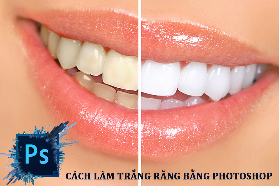 7+ Cách Làm trắng răng trong Photoshop