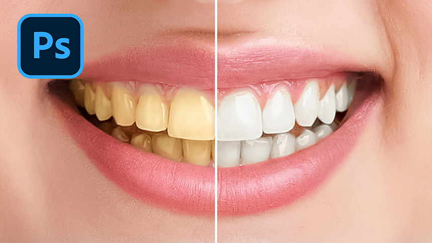 Loại bỏ răng ố vàng để có hàm răng trắng tinh bằng cách này